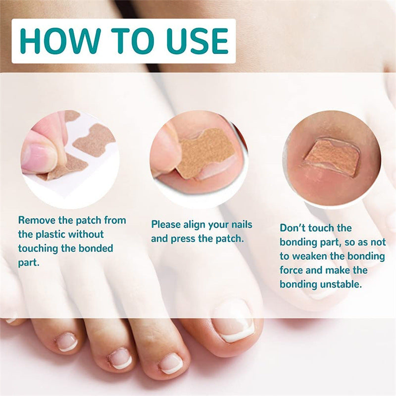 Glue-free Orthopedic Toenail Groove Inlay Corrector Onychomycosis Toe Care Corrector Inflammation Toenail Patch