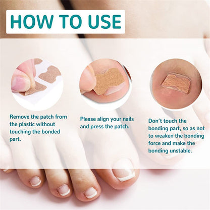 Glue-free Orthopedic Toenail Groove Inlay Corrector Onychomycosis Toe Care Corrector Inflammation Toenail Patch